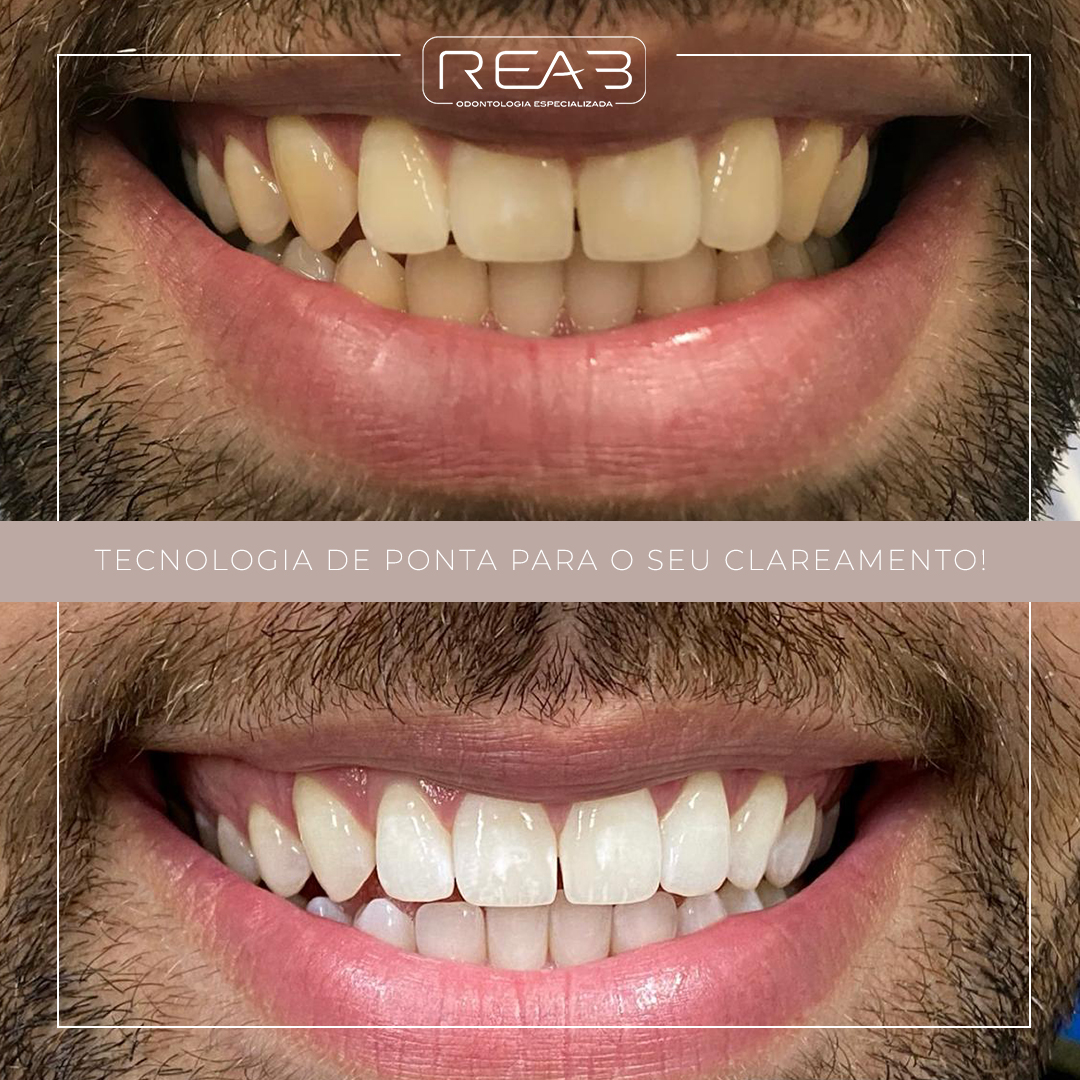 Tecnologia de ponta para o seu clareamento